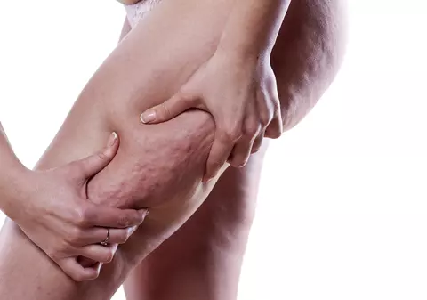 EXCLUSIV/ Cum tratăm celulita acasă. Medicul estetician Adina Alberts are soluția