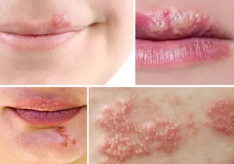 Cum îţi dai seama dacă ai herpes sau zona zoster