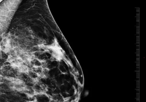 Sănătate: Nodul la sân înseamnă cancer?