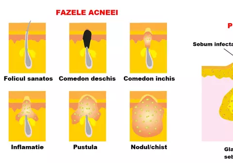 Îndepărtează coşurile de pe faţă cu fulgi de ovăz