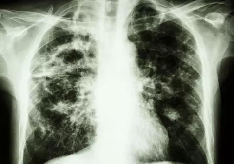 Statistică îngrijorătoare: Suntem țara membră a Uniunii Europene cu cele mai multe cazuri noi de tuberculoză înregistrate