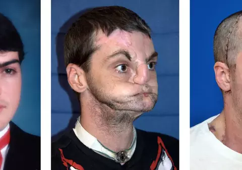 Transformare uluitoare! Cum arată acum bărbatul care a suferit un transplant de faţă în urmă cu doi ani | FOTO