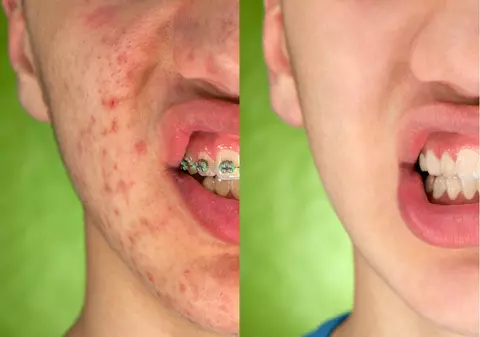 Crema ieftină care te ajută să scapi de acnee