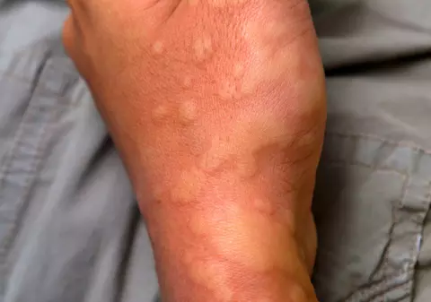 Alergiile cutanate si urticaria