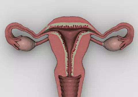 Ce sunt chisturile vaginale și cum le identifici