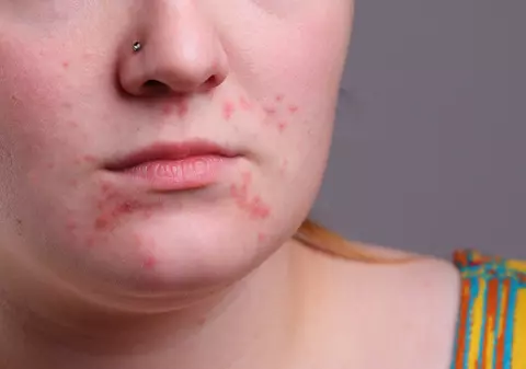 5 alimente sănătoase care înrăutăţesc acneea