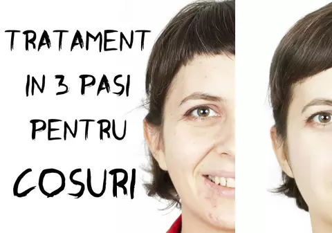 Tratament în 3 pași pentru acnee