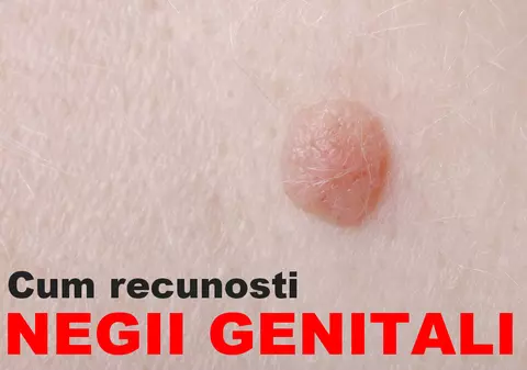 Cum știi că ai negi genitali