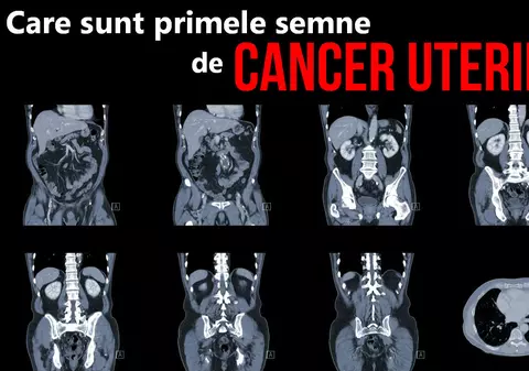 Simptomele cancerului uterin. Vezi care sunt primele semne