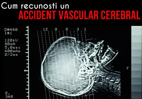 Accidentul vascular cerebral