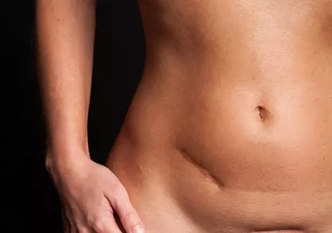 Ce se întâmplă dacă ţi se rupe un chist ovarian