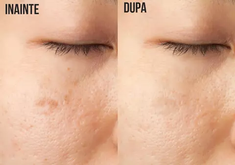 Cum scapi de petele de pe faţă în mod natural