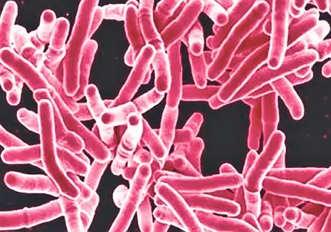 Tuberculoza ucide tot mai mulţi oameni