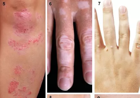 Cât de contagioase sunt, de fapt, bolile de piele?
