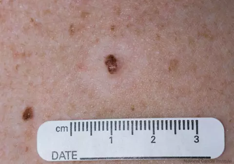 Cum recunoști melanomul