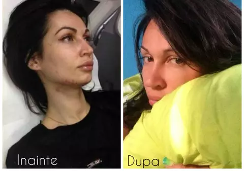 Cum a scăpat Nicoleta Luciu de acnee. Coşurile au dispărut în timp record!