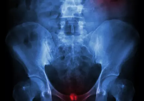 Care sunt simptomele cancerului la vezica urinară