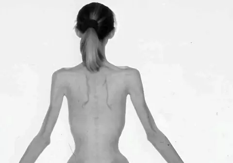Foto: cum arăta adolescenta de 31 de kilograme