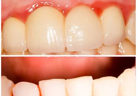 Cum știi că suferi de boli ale gingiilor