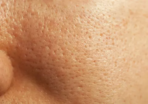 3 metode naturale prin care să-ţi micşorezi porii