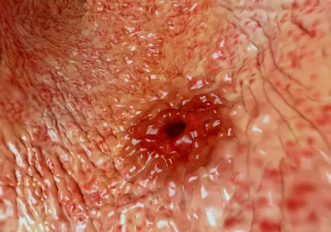 Care este medicamentul care provoacă ulcer şi gastrită