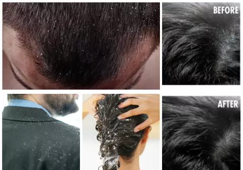 Cel mai simplu remediu natural pentru mătreaţă