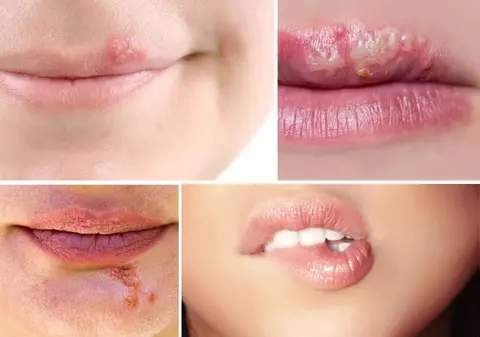 Cum îţi dai seama dacă ai herpes sau zona zoster
