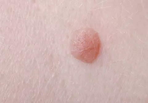 Cum știi că ai luat virusul HPV