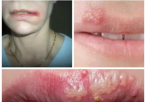 Cum scapi de herpes peste noapte