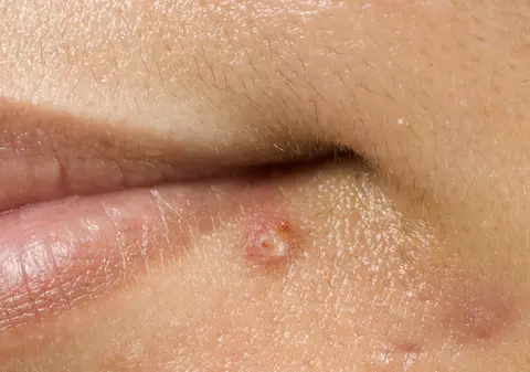 Prea mult par = Hirsutism