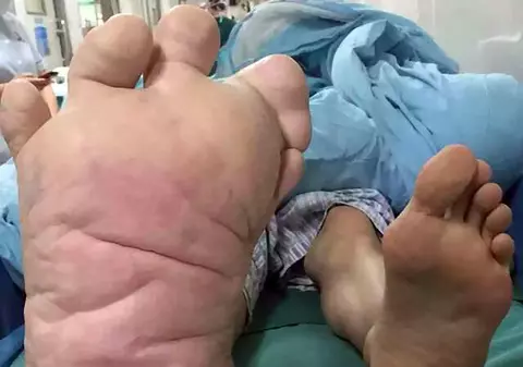 Un tânăr din China are un picior de 43 de centimetri 