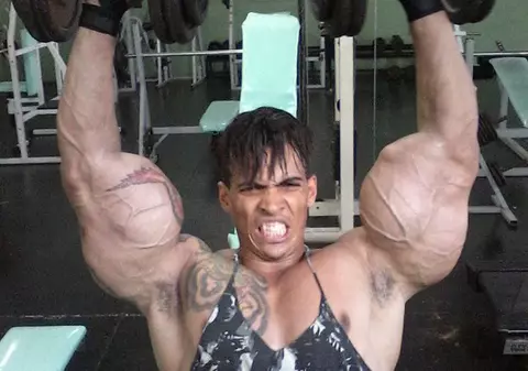 Şi-a injectat ulei şi alcool în braţe pentru a avea muşchi uriaşi. Acum regretă enorm: "Copiii mă strigă «Monstrul»"