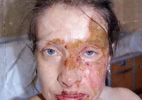 A rămas MARCATĂ PE VIAŢĂ, după ce fostul ei IUBIT i-a turnat APĂ FIARTĂ pe faţă. Totul pentru că ea nu a mai vrut să se împace cu el. IMAGINI INCREDIBILE