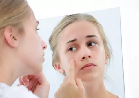 CUM ÎŢI DAI SEAMA CĂ AI ACNEE HORMONALĂ
