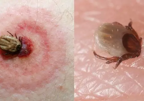 Boala Lyme: riscul de infectare este mic!