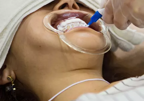 Şi-a lipit toată viaţa dinţii cu superglue pentru că se temea de dentist. Cum arată dantura femeii VIDEO