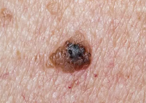 Cum recunoști melanomul