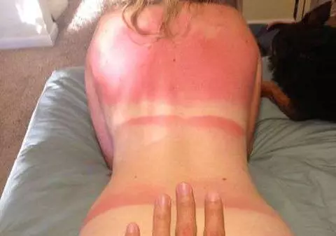 OUCH! Uite cum s-au ars pe plajă acești tineri! GALERIE FOTO 