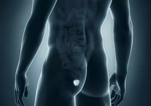 Care sunt primele semne de cancer de prostată