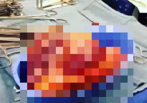 IMAGINI ŞOCANTE! Efectul cocainei asupra corpului uman! Inima unui pacient a bătut timp de 25 de minute după ce a fost scoasă din piept | VIDEO