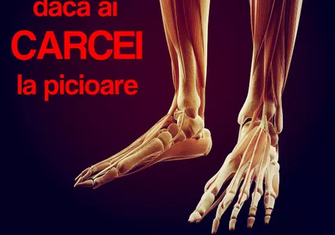 Suferi de cârcei? Vezi motivele pentru care apar şi află cum să scapi de ei