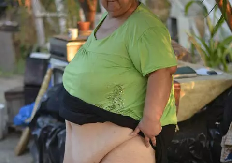 Drama buzoiencei care suferă de "boala picioarelor de elefant". Are 200 de kilograme şi se îngraşă pe zi ce trece 