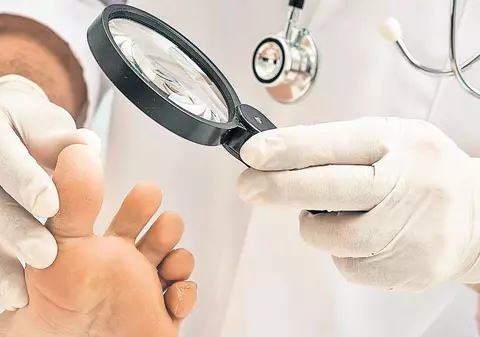 Cum recunoaştem şi cum tratăm ciuperca piciorului şi micozele unghiilor