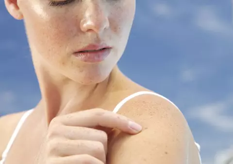 Ai multe alunițe? Care este numărul care ar trebui să te îngrijoreze