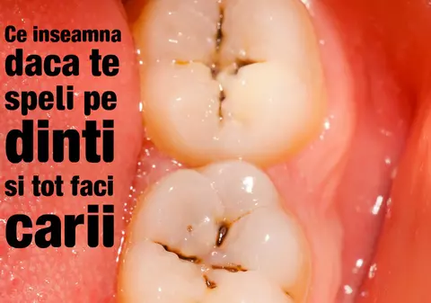 Ce boli poţi să ai dacă ţi se strică dinţii repede