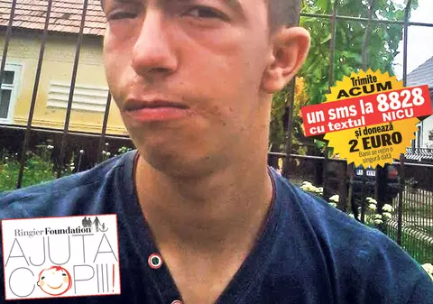 Nicuşor are nevoie de ajutor! Un adolescent de 17 ani cu cerul gurii despicat în două poate fi operat în Turcia