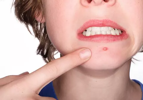 Cum elimini DEFINITIV acneea