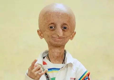 Băieţelul care suferă de "boala lui Benjamin Button" i-a uimit pe medici. Are 15 ani, dar arată de 80