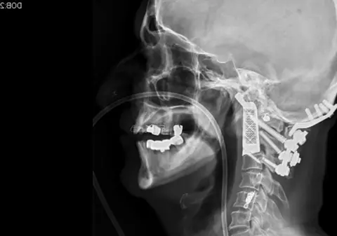 Au reuşit prima operaţie cu vertebră artificială, printată 3D