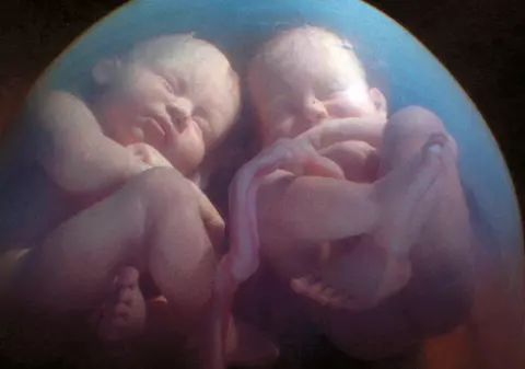 Caz extrem de rar în Vietnam. O femeie a născut gemeni cu taţi diferiţi